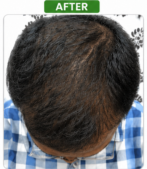 After Hair Transplant