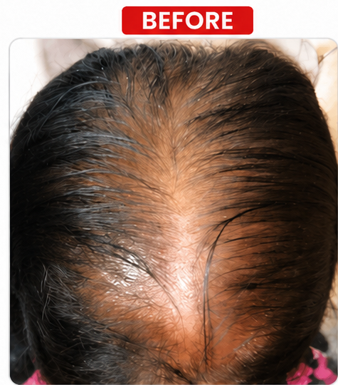 Before Hair Density Treatment